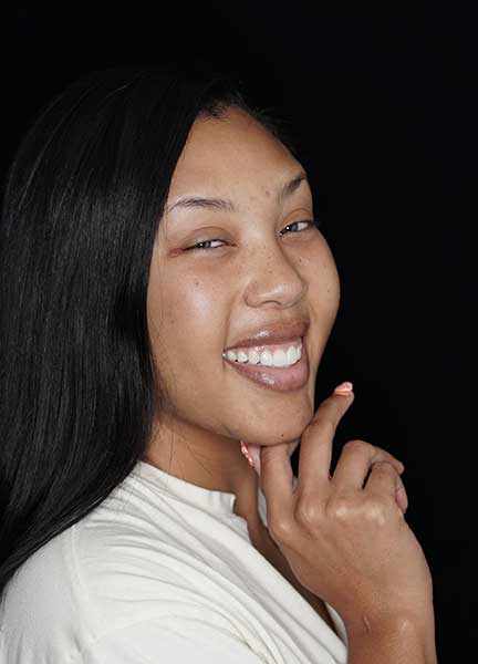 Composite Veneers