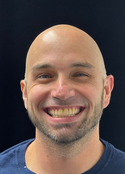 Composite Full Mouth Restoration