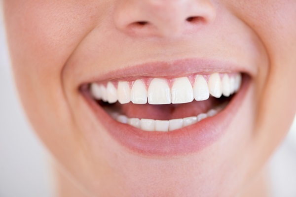 How Fluoride Can Relieve Sensitivity After Teeth Whitening